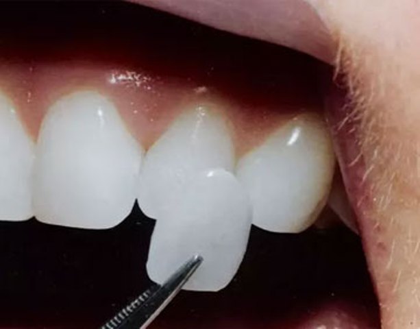 Replacement of missing teeth