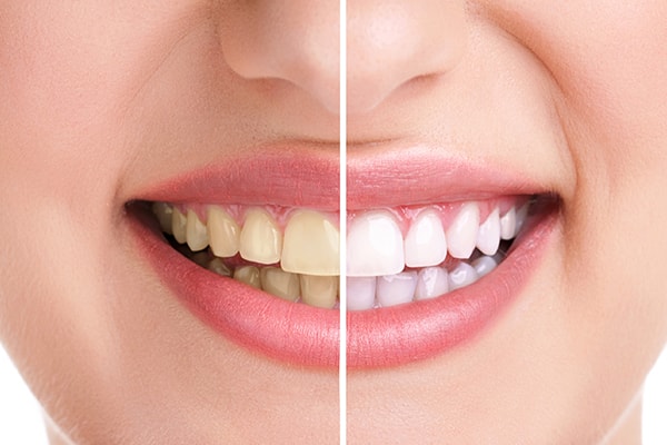 teeth whitening