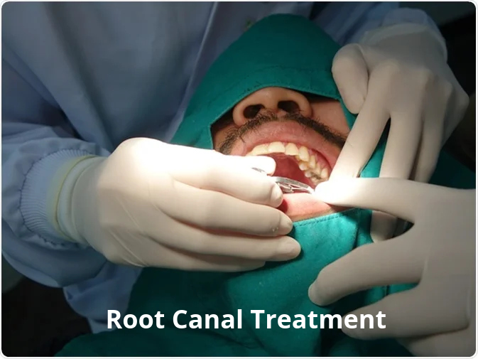 root canal treatment in Kolkata
